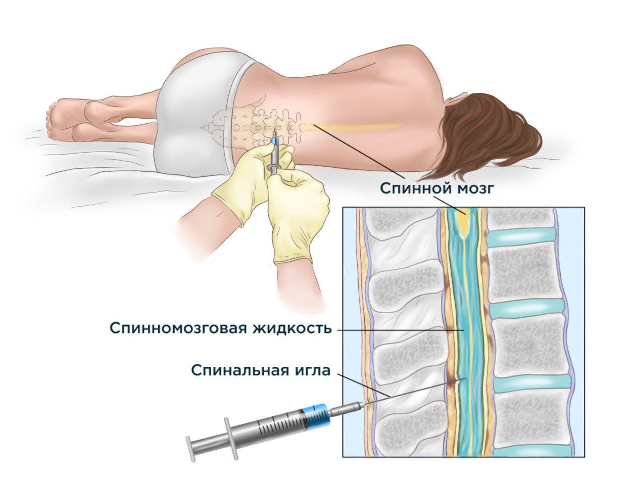 Спинномозговая (люмбальная) пункция – это забор спинномозговой жидкости, который осуществляется путем прокола оболочки спинного мозга специальной иглой в области поясницы.