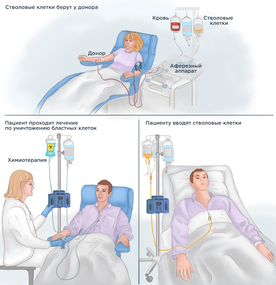 ТГСК дает возможность заменить поврежденные кроветворные клетки пациента новыми и здоровыми клетками донора. Донорами могут выступать как родственники, так и неродственные пациенту лица, которые обладают максимальными параметрами совместимости с ним.