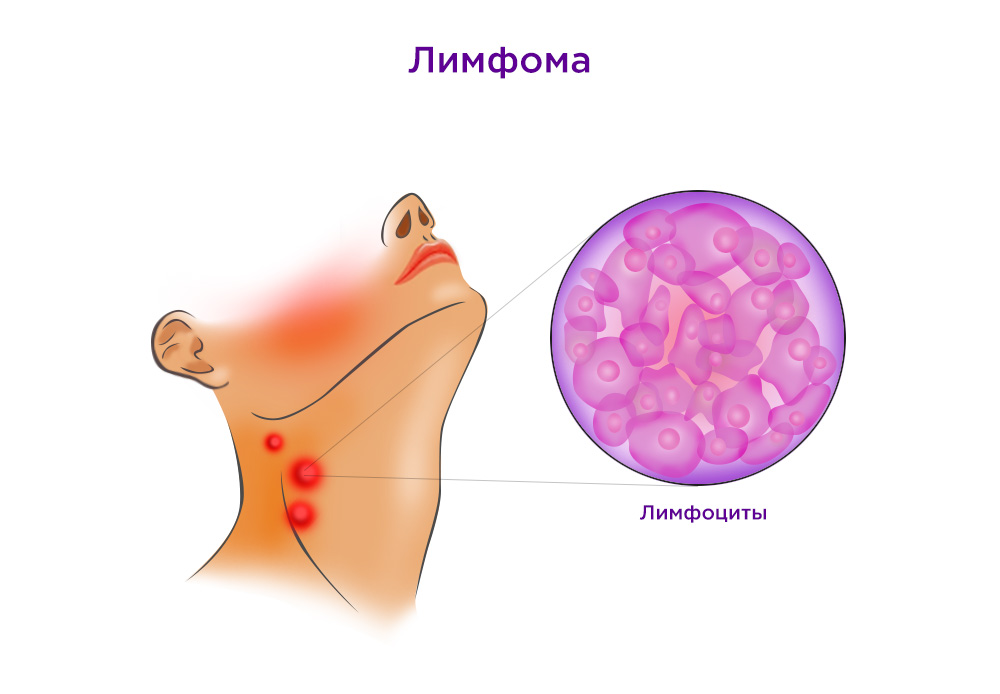 В силу того, что лимфатическая ткань есть везде, первичное возникновение опухоли также возможно в разных местах, однако чаще всего болезнь развивается в лимфоузлах.
