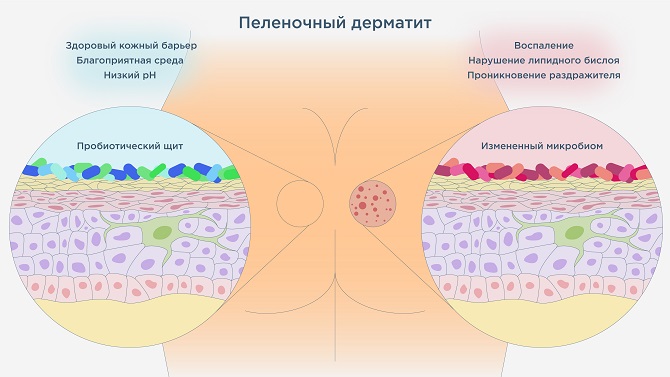Как выглядит пеленочный дерматит у детей Как выглядит пеленочный дерматит у детей