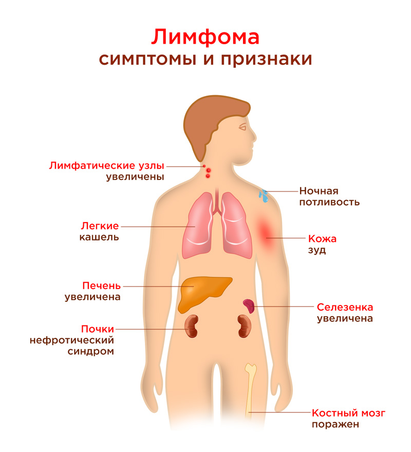 Причина заболевания лимфомы