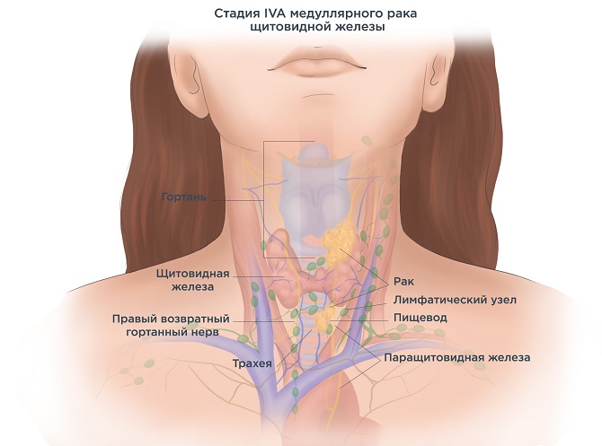Метастазы при раке щитовидной железы