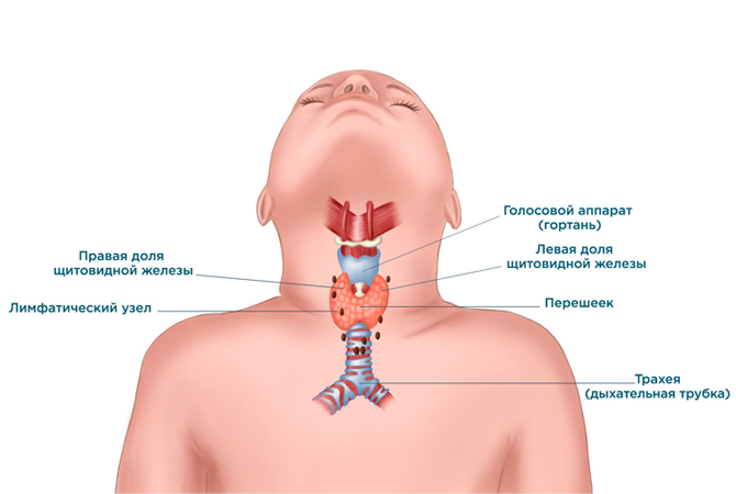Метастазы при раке щитовидной железы