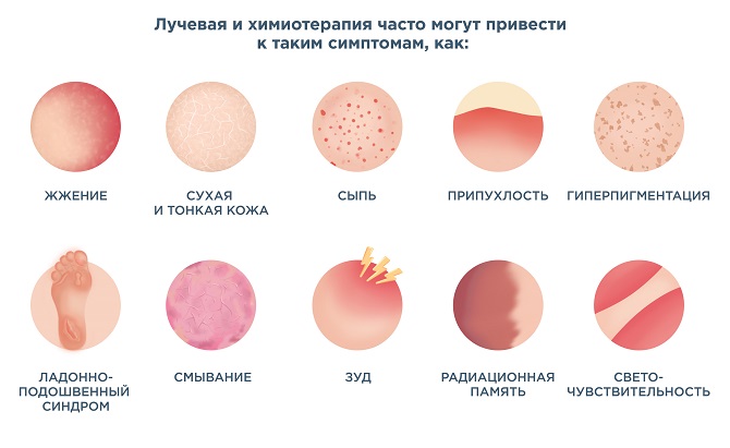 Температура после лучевой