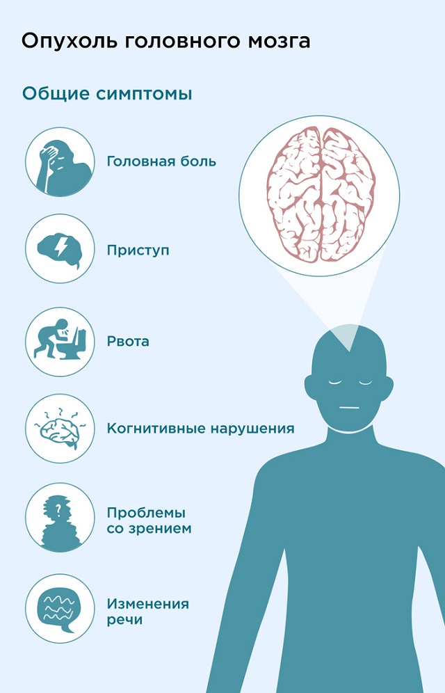 Рак мозга степени. Симптомы опухоли головного. Опухоль в голове симптомы. Симптомы при опухоли головного мозга. Симптомы онкологии мозга.