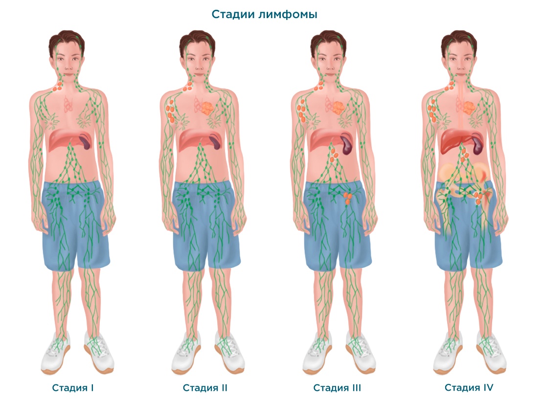 У лимфомы Ходжкина и неходжкинских лимфом схожий принцип стадирования – в зависимости от количества вовлеченных лимфоузлов и других органов и систем. Однако детали всех 4 стадий будут отличаться в зависимости от конкретного типа заболевания.