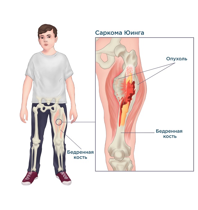 Онкология мягких тканей симптомы и признаки фото Онкология мягких тканей симптомы и признаки фото